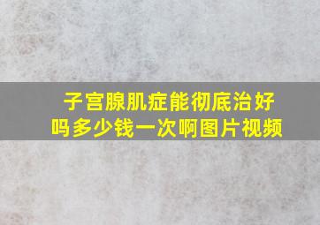 子宫腺肌症能彻底治好吗多少钱一次啊图片视频