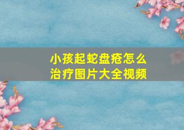 小孩起蛇盘疮怎么治疗图片大全视频