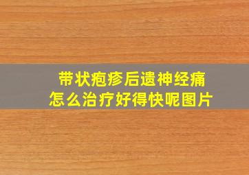 带状疱疹后遗神经痛怎么治疗好得快呢图片