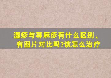 湿疹与荨麻疹有什么区别、有图片对比吗?该怎么治疗