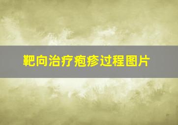 靶向治疗疱疹过程图片