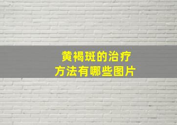 黄褐斑的治疗方法有哪些图片